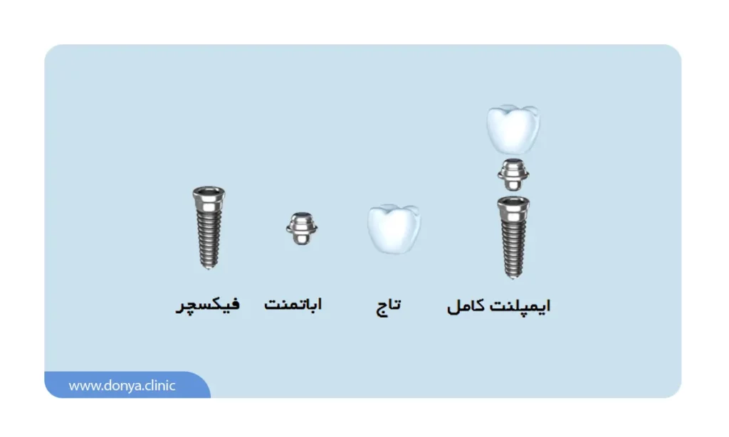 اینفوگرافی اجزای مختلف ایمپلنت + شکل ایمپلنت