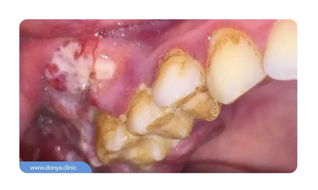 زخم دهان ناشی از سرطان دهان