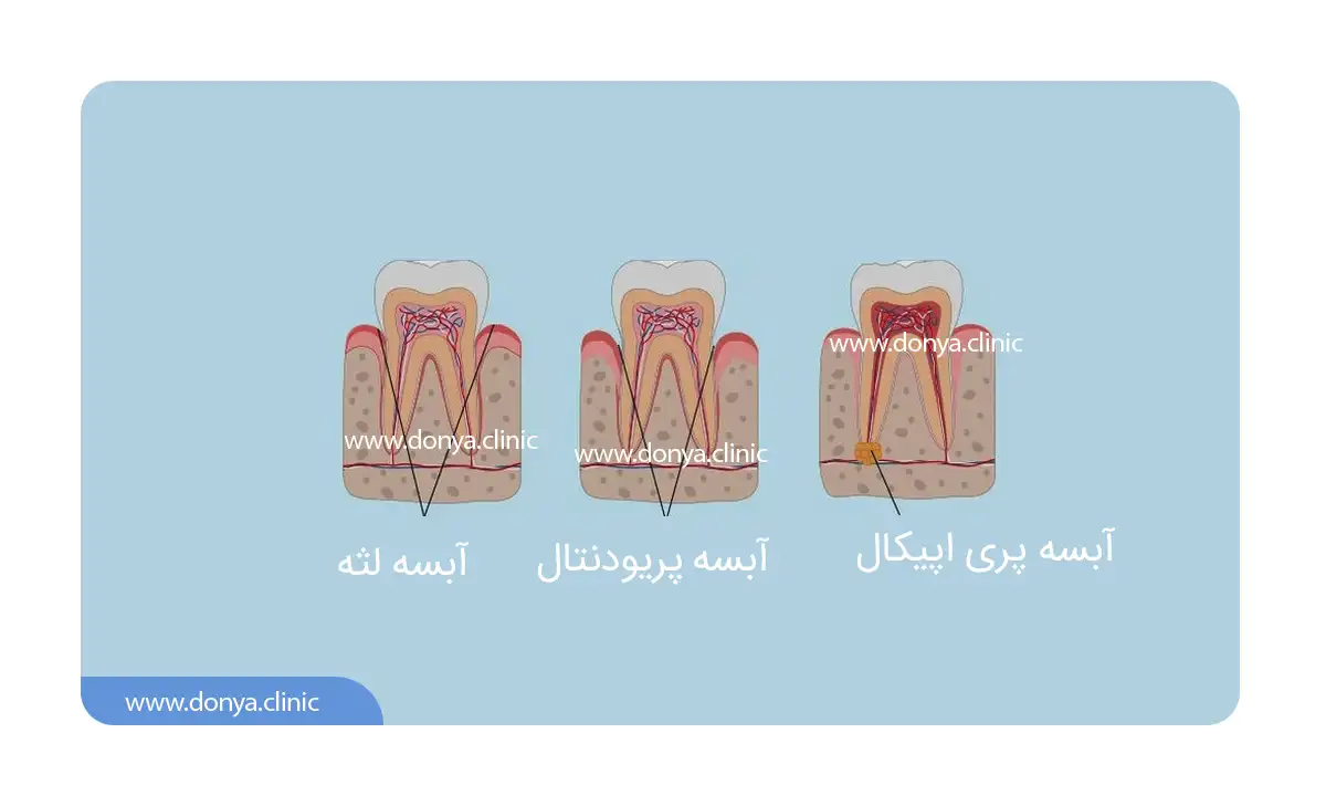 عکس انواع آبسه به عنوان زخم دهان