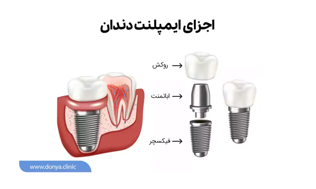 اجزای ایمپلنت دندان