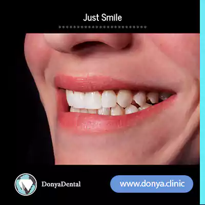 تصویر ایمپلنت فک بالا