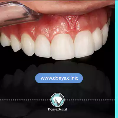 نمونه کار نصب 8 واحد ایمپلنت فک بالا