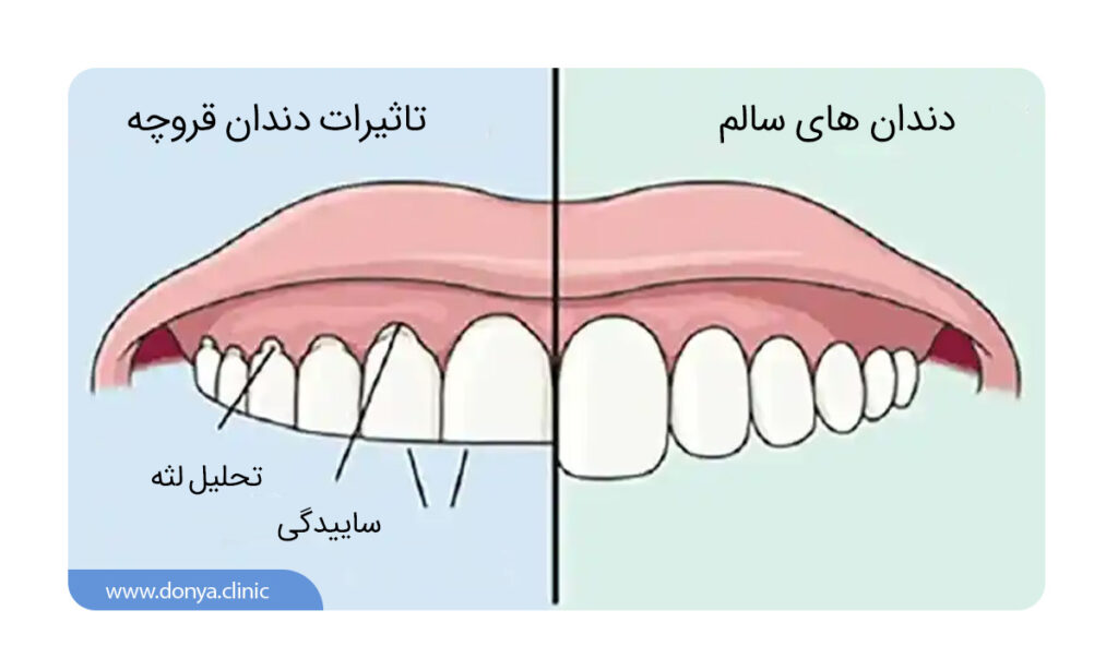 فرسایش لمینت از طریق دندان قروچه