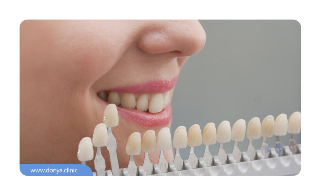 تعادل هارمونی بین رنگ لمینت و سایر دندان های طبیعی