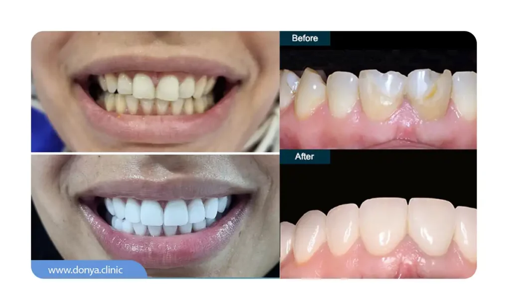 عکس قبل و بعد از کامپوزیت ونیر دندان