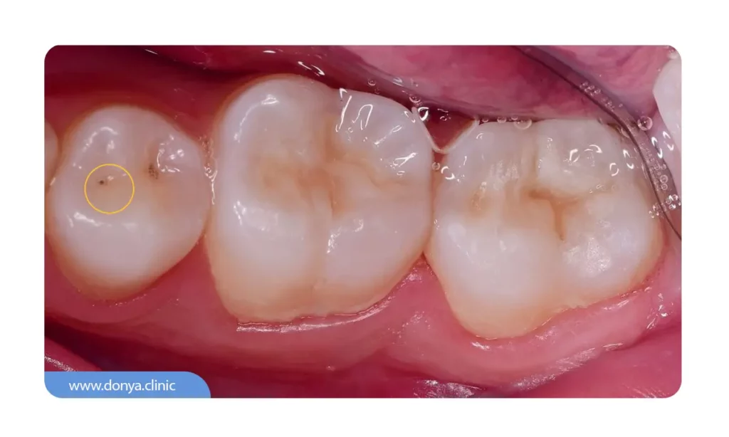 پوسیدگی دندان قبل از نصب لمینت