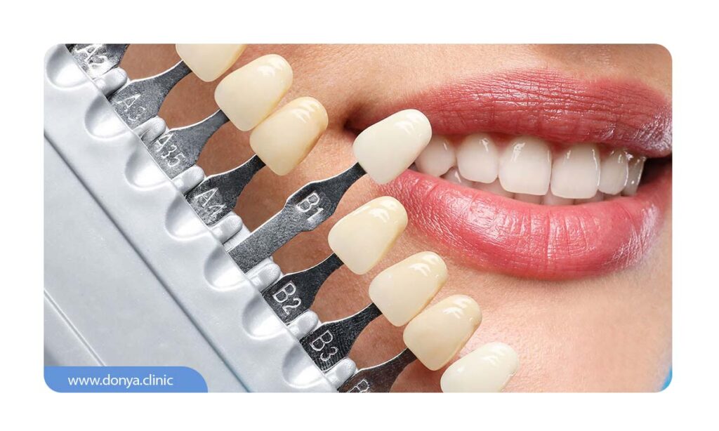 انتخاب رنگ مناسب لمینت دندان