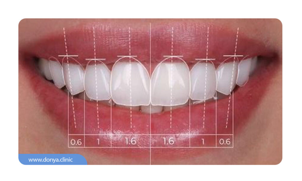 ترمیم دندان های جلویی فک بالا با روکش لمینت