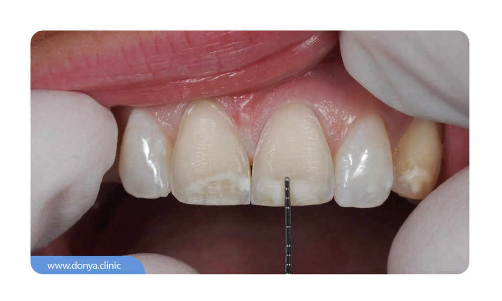 تصویر دندان لمینت شده در کنار سایر دندان ها