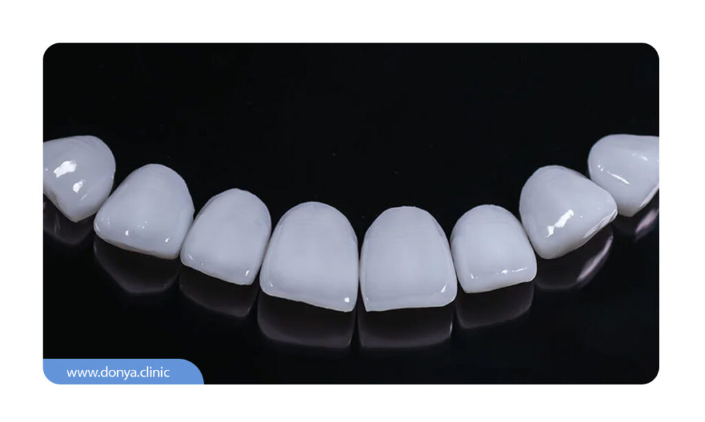 روکش های لمینت- 8-دندان قدامی فک بالا و پایین