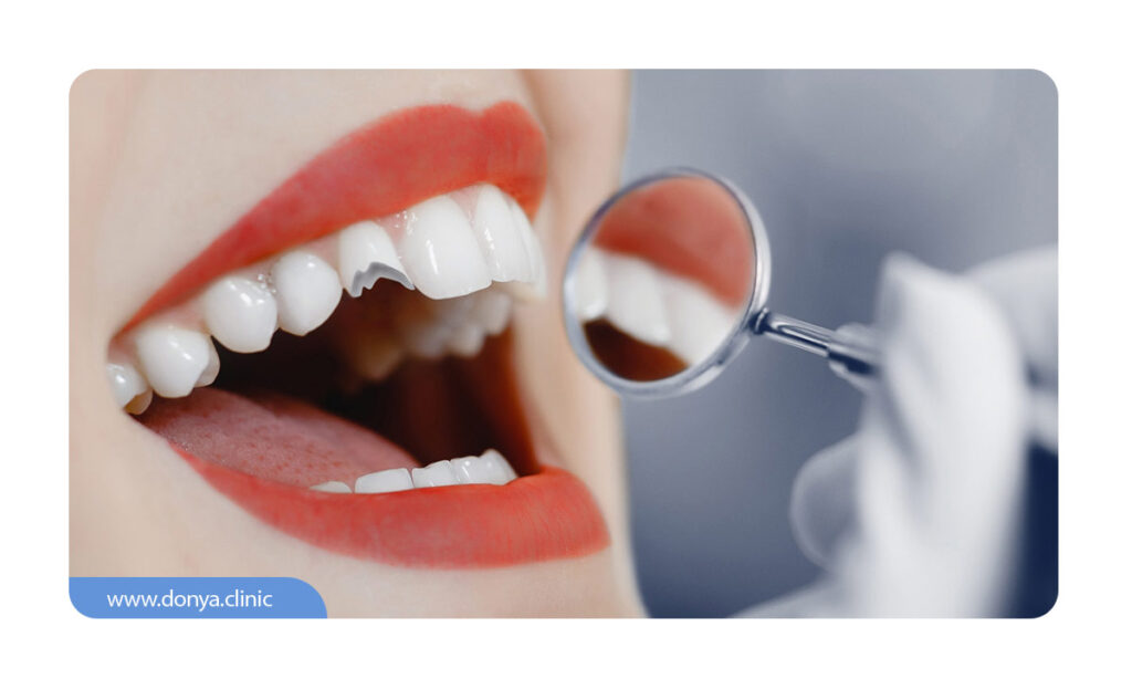 عکس از شکستگی لمینت دندان