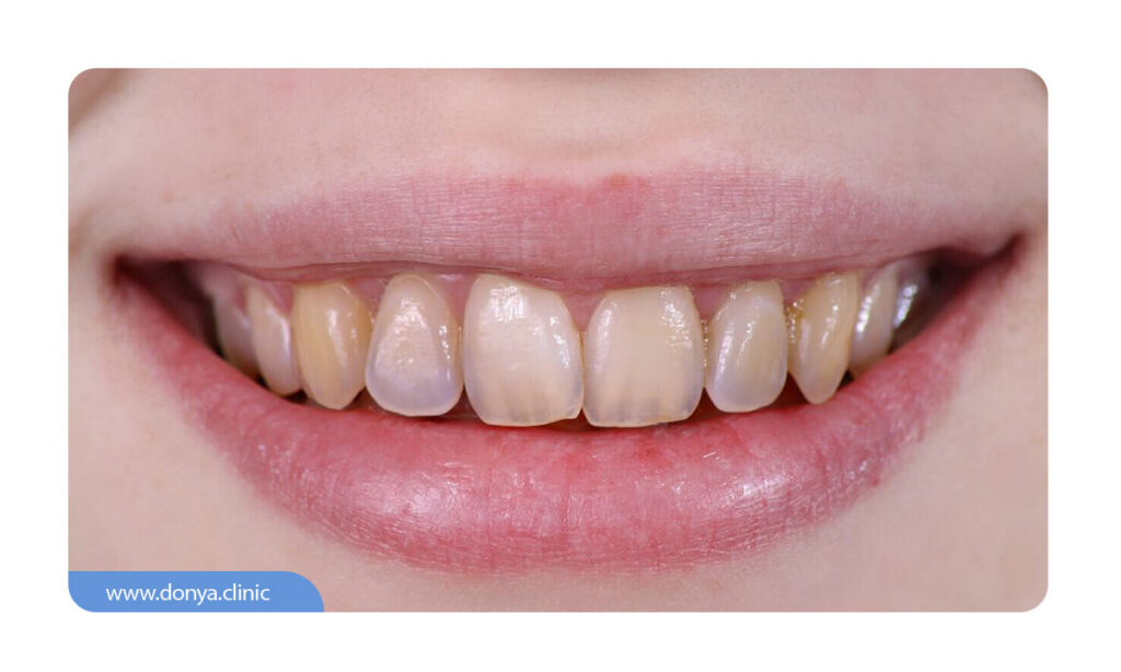 عکسی از فرسایش مینای دندان