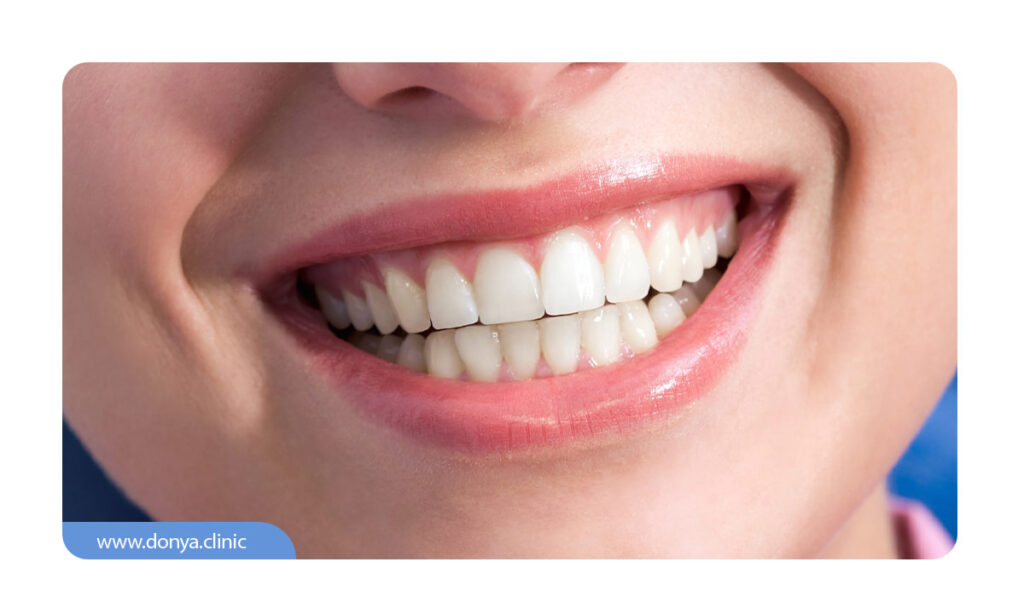 عکسی از لبخند زیبا با دندان های لمینت شده