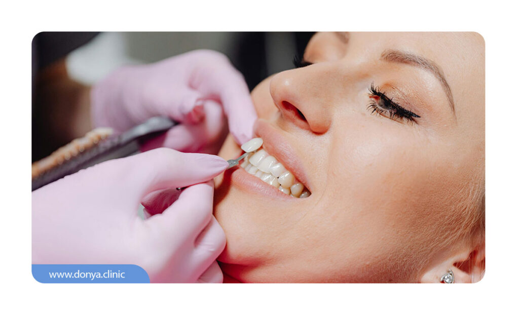 عکسی از نصب روکش لمینت سرامیکی بر روی دندان