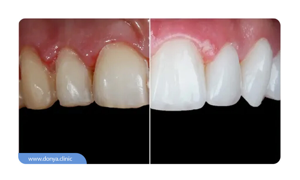 عکسی از اصلاح تغییرات رنگی دندان ها با نصب باندنیگ لمینت