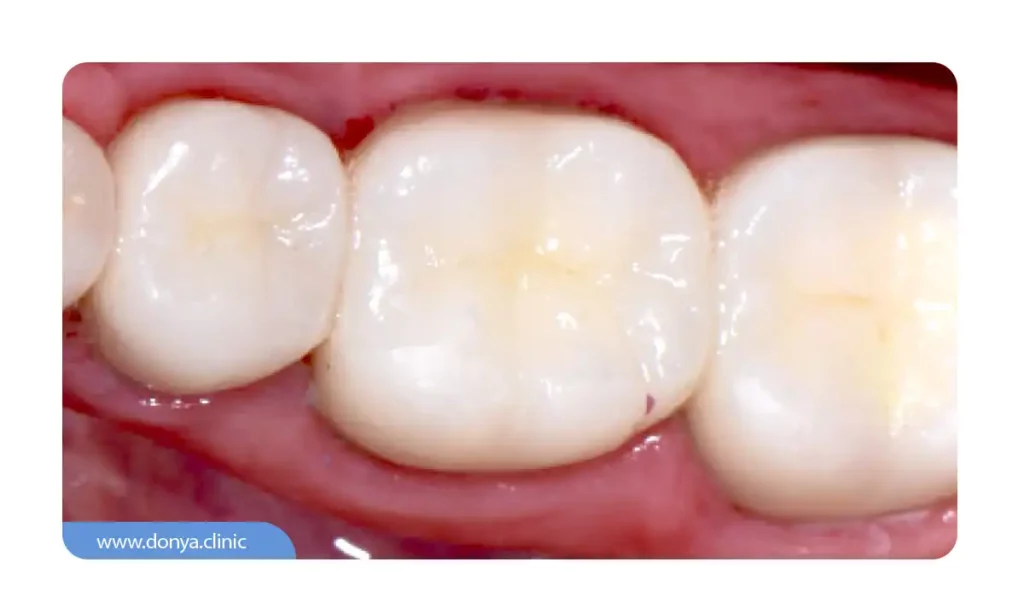 عکس 3 واحد دندان که با کمک کامپوزیت پر شده اند