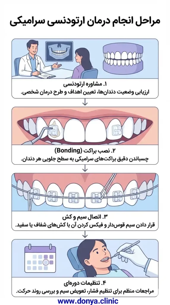 مراحل انجام ارتودنسی سرامیکی 