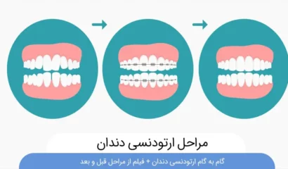 مراحل ارتودنسی دندان