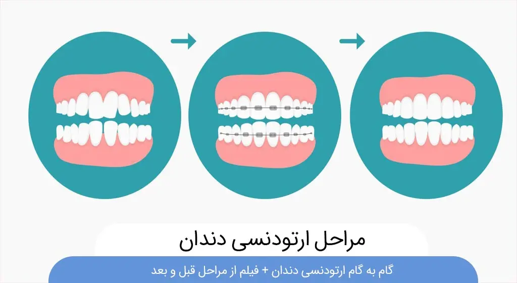 مراحل ارتودنسی دندان