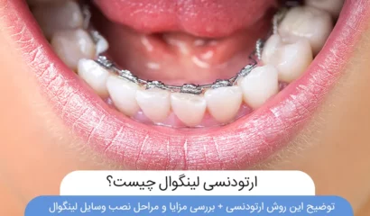 ارتودنسی لینگوال چیست