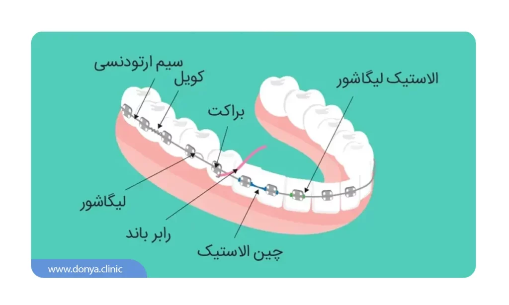  اجزای تشکیل دهنده ارتودنسی ثابت شامل براکت ، سیم ،لگاشور ، رابرباند و موارد دیگر است.
