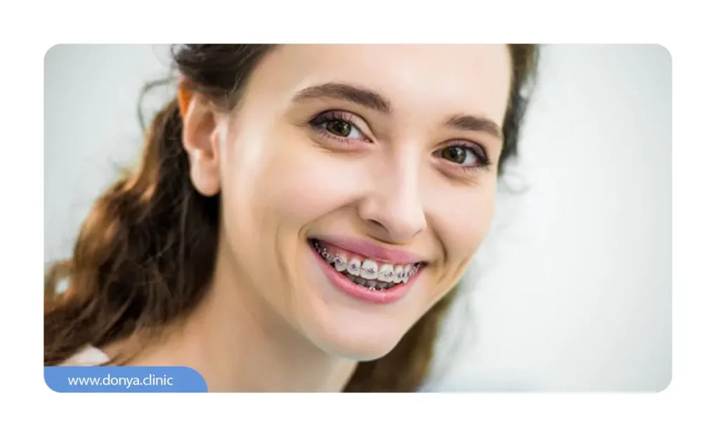 پس از قرار دادن ارتودنسی ثابت،قرار های دوره ای برای تنظیم بریس ها برنامه ریزی می شود.