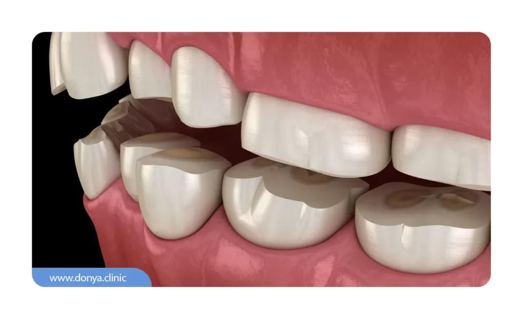 عکس سایش دندان ها به صورت شماتیک