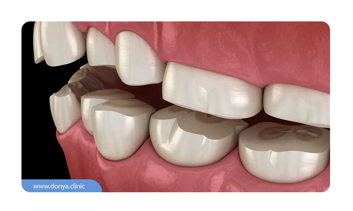 از تاثیرات دندان قروچه بر روی دندان ها  ساییده شدن آن هاست.