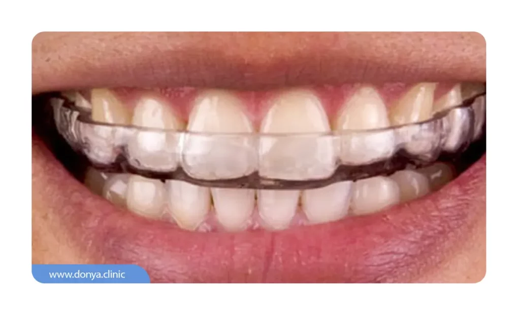 تصویر نایت گارد بر روی دندان 