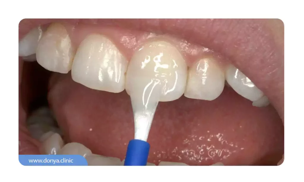 فلورایدتراپی