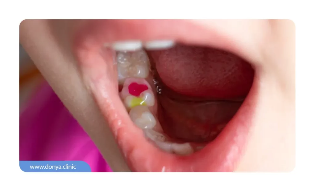 عکس پر کردن دندان با کمک متخصص دندانپزشکی کودکان