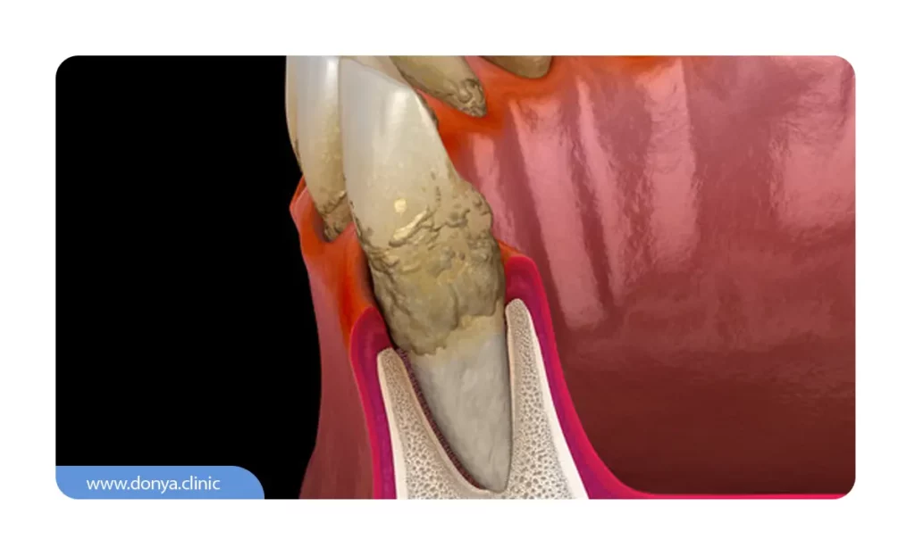 عکس پلاک دندان و تحلیل لثه