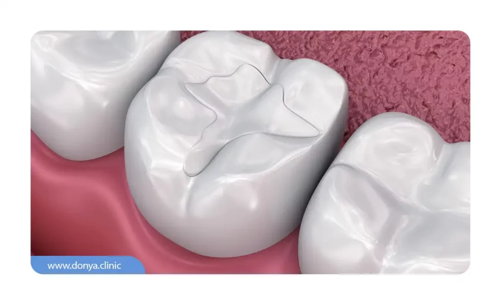 درمان حساسیت دندان ها