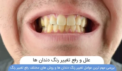 تغییر رنگ دندان ها