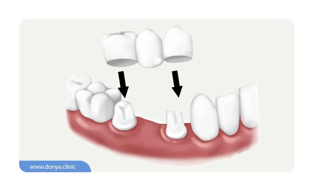 بریج دندان سنتی