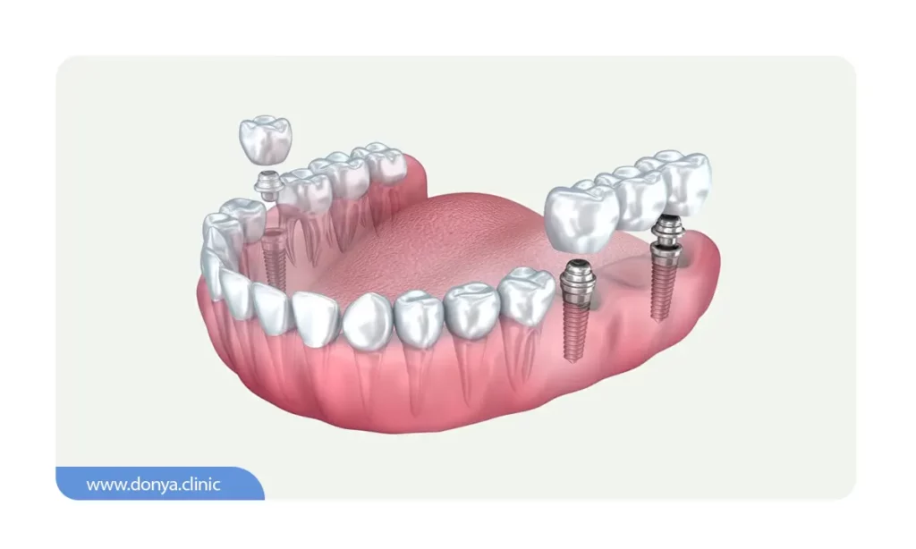 بریج دندان متکی بر ایمپلنت