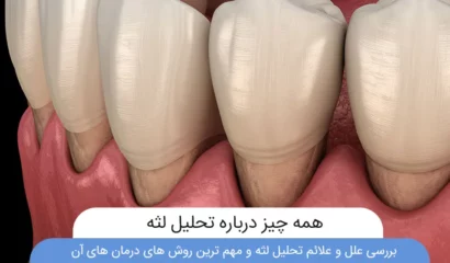 عکس تحلیل لثه