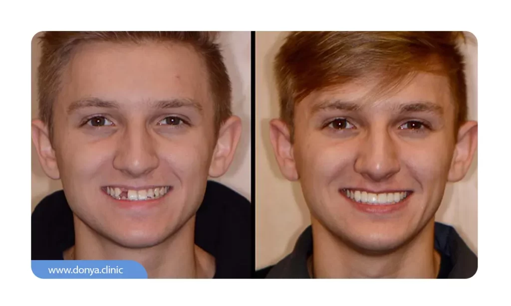عکس قبل و بعد از بریج دندان
