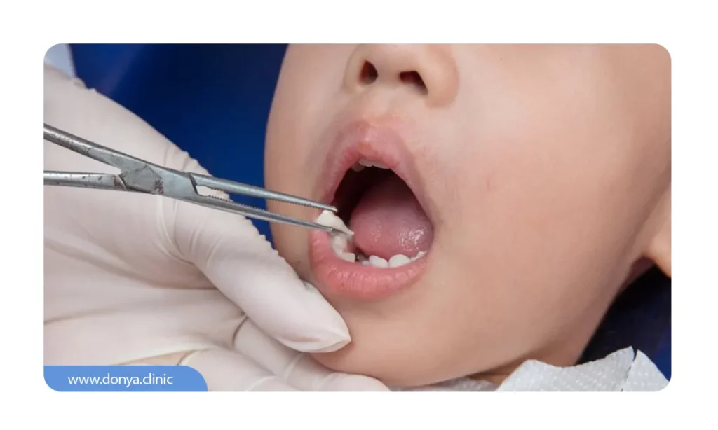 عکس کشیدن دندان توسط متخصص دندانپزشکی کودکان