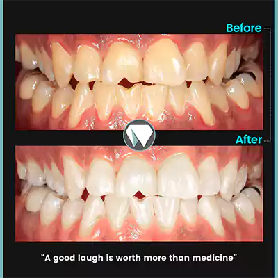 تصویر قبل و بعد بلیچینگ دندان