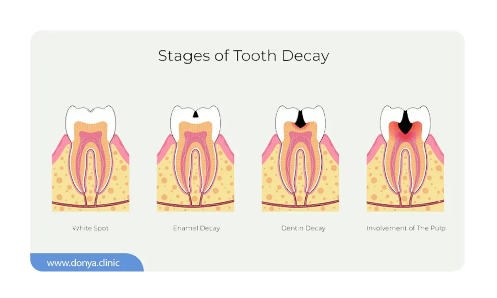 مراحل پوسیدگی دندان