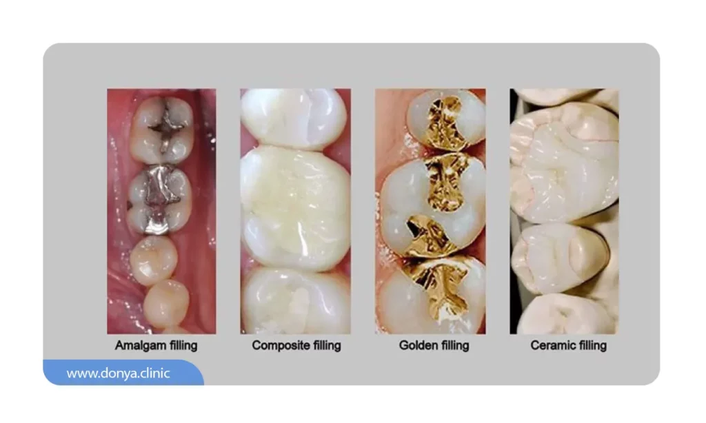 پر کردن دندان پوسیده