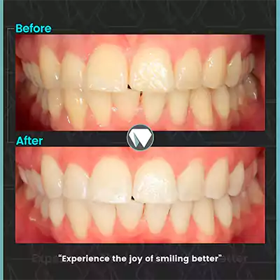 یک نمونه عکس قبل و بعد بلیچینگ دندان