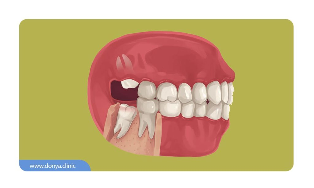 کشیدن دندان عقل نهفته