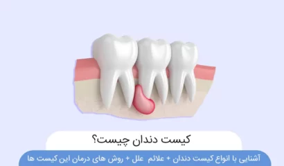 عکس کیست دندان