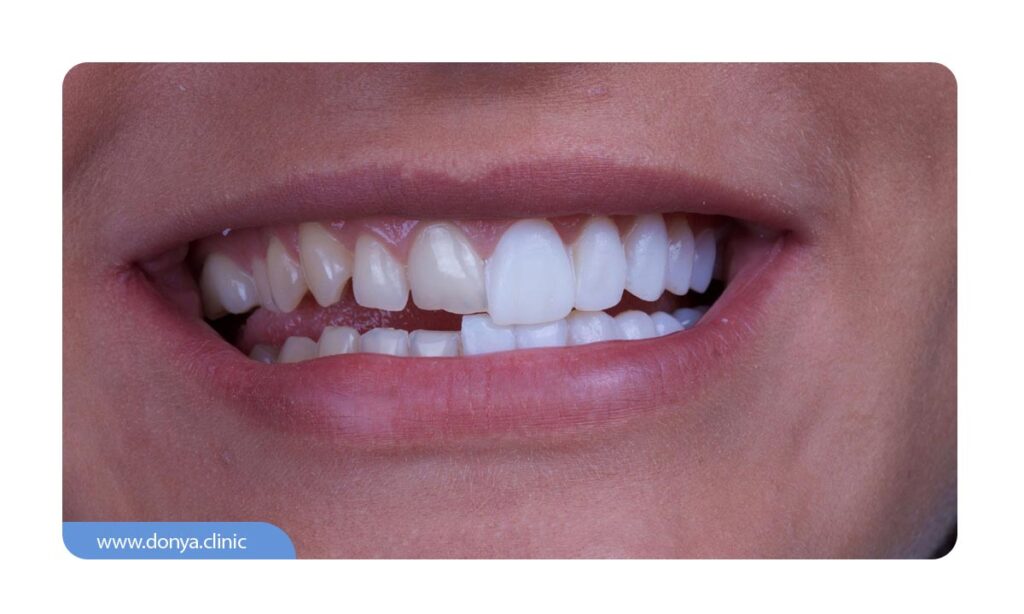 ارتباط لمینت و پوسیدگی دندان