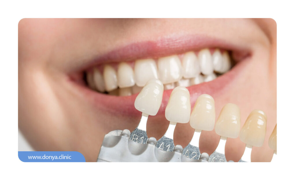 انتخاب بهترین رنگ لمینت دندان با در نظر گرفتن رنگ سایر دندان های طبیعی