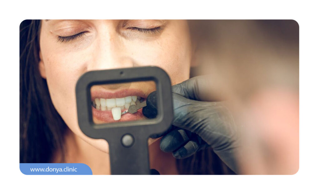 تغییر رنگ لمینت دندان جز مضرات لمینت دندان در دراز مدت