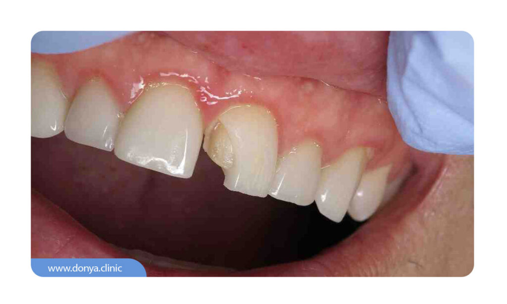 شکستن یا لب پر شدن لمینت دندان