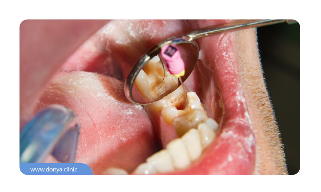 تصویری از عصب کشی دندان